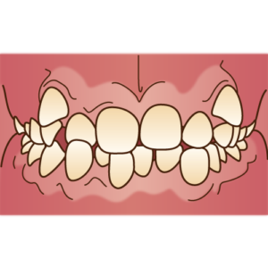 歯の叢生